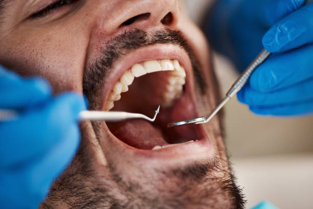 Best Emergency Dentist for Lost Fillings or Crowns in Lyons, KS